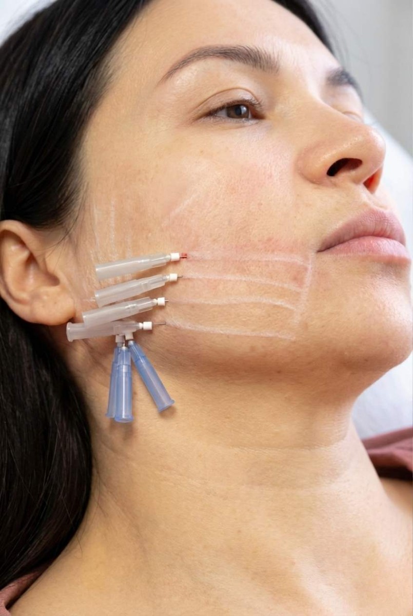 Hilos PDO Lifting sin Cirugía