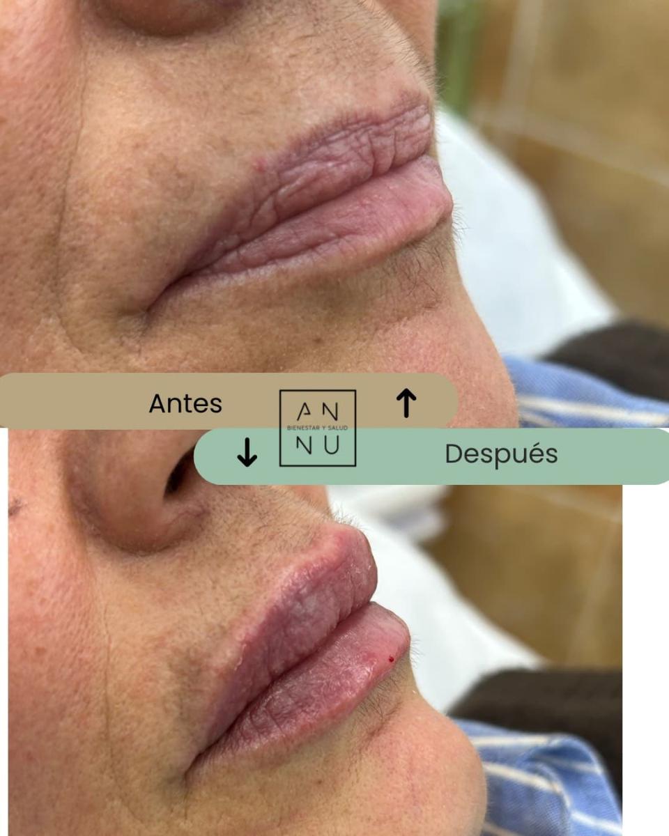 Resultados Ácido Hialurónico - Antes y Después