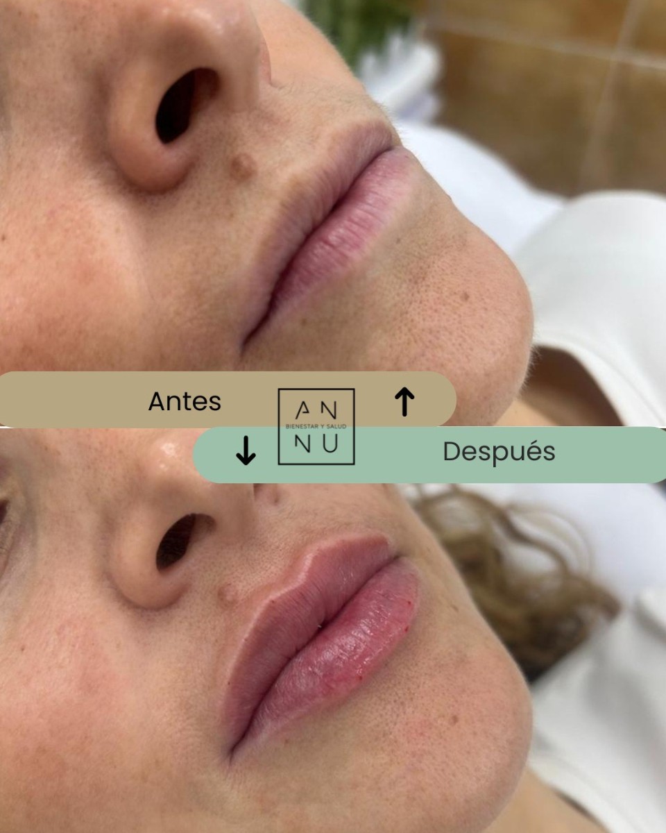 Resultados Ácido Hialurónico