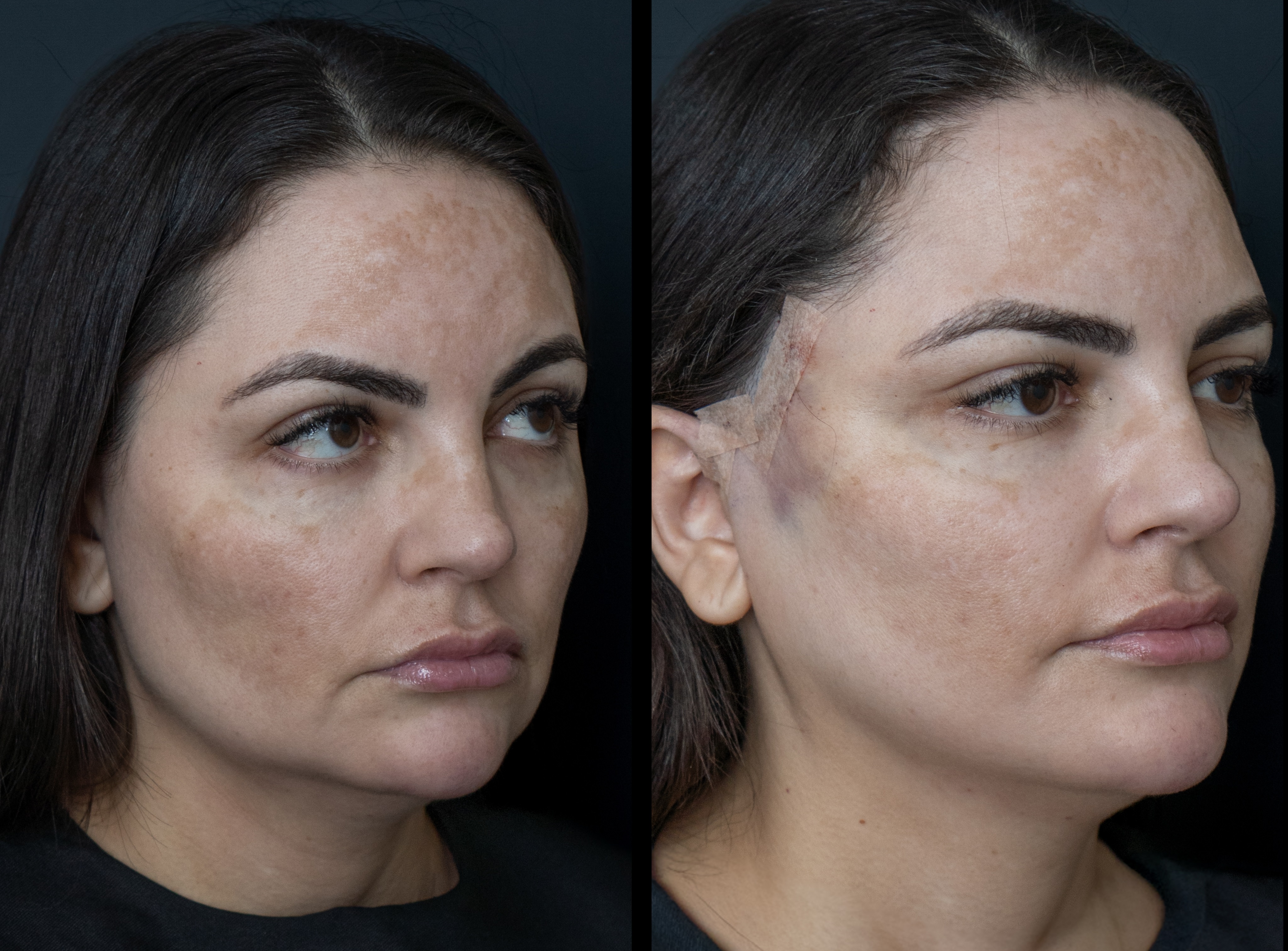 Antes e depois - Mini Lifting Facial