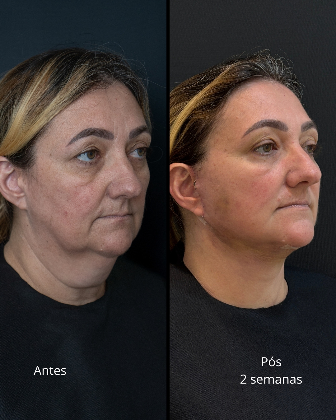 Antes e depois - Lifting Facial Full Face