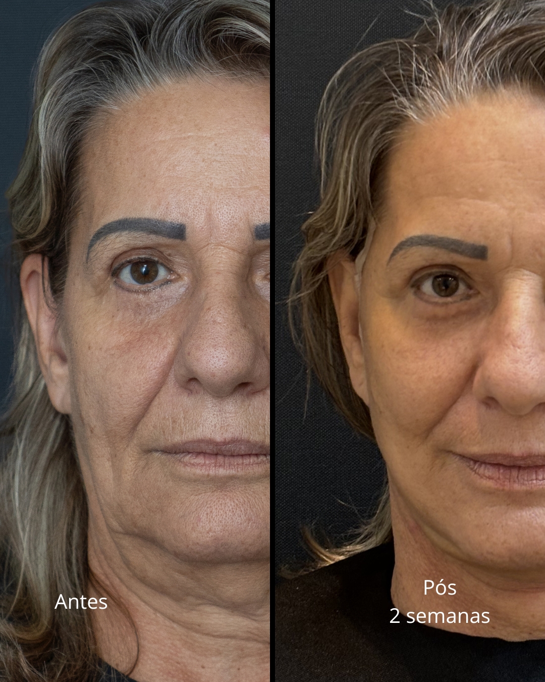 Antes e depois - Lifting Facial Full Face