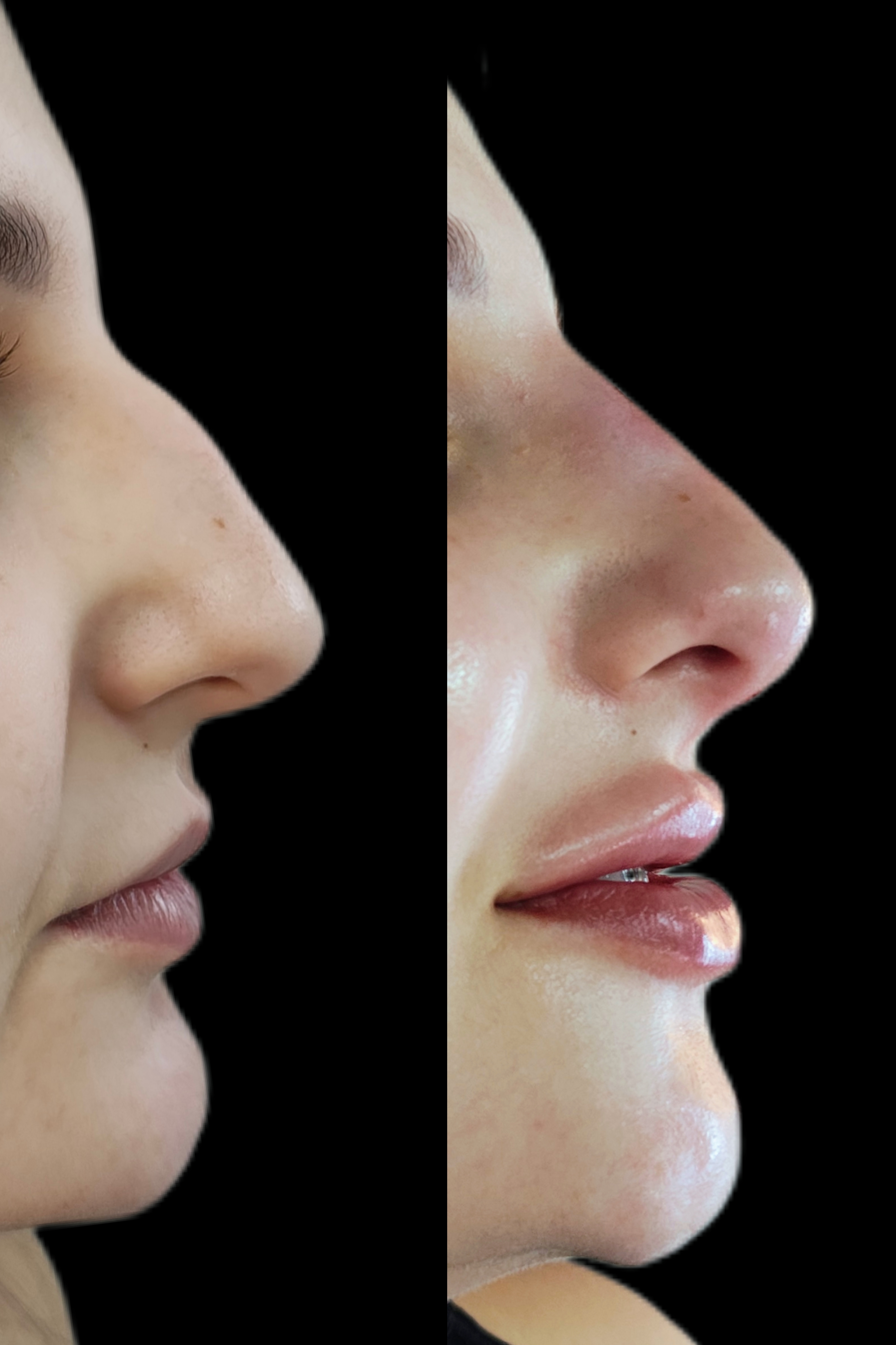 Antes e depois - Rinomodelação