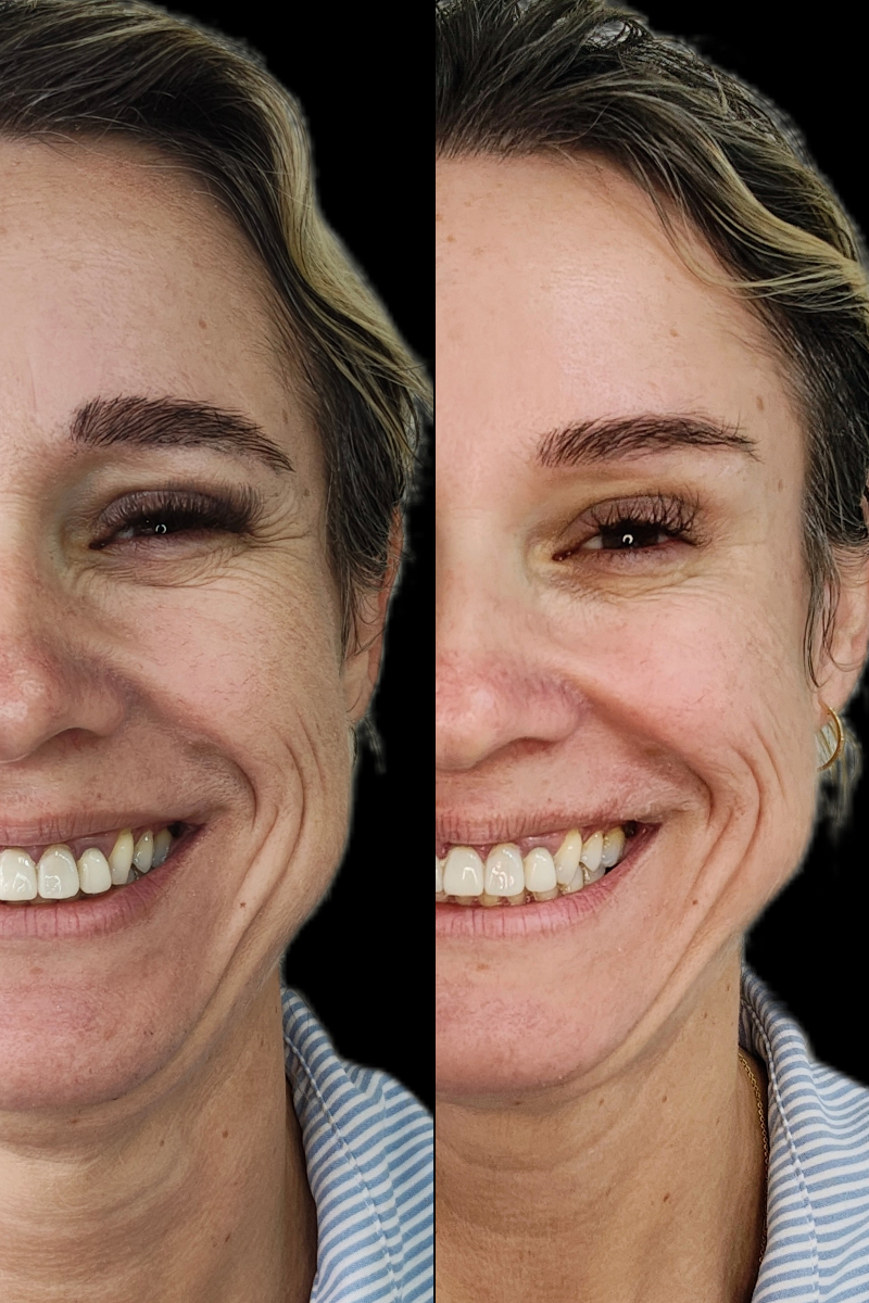 Antes e depois - Toxina Botulínica