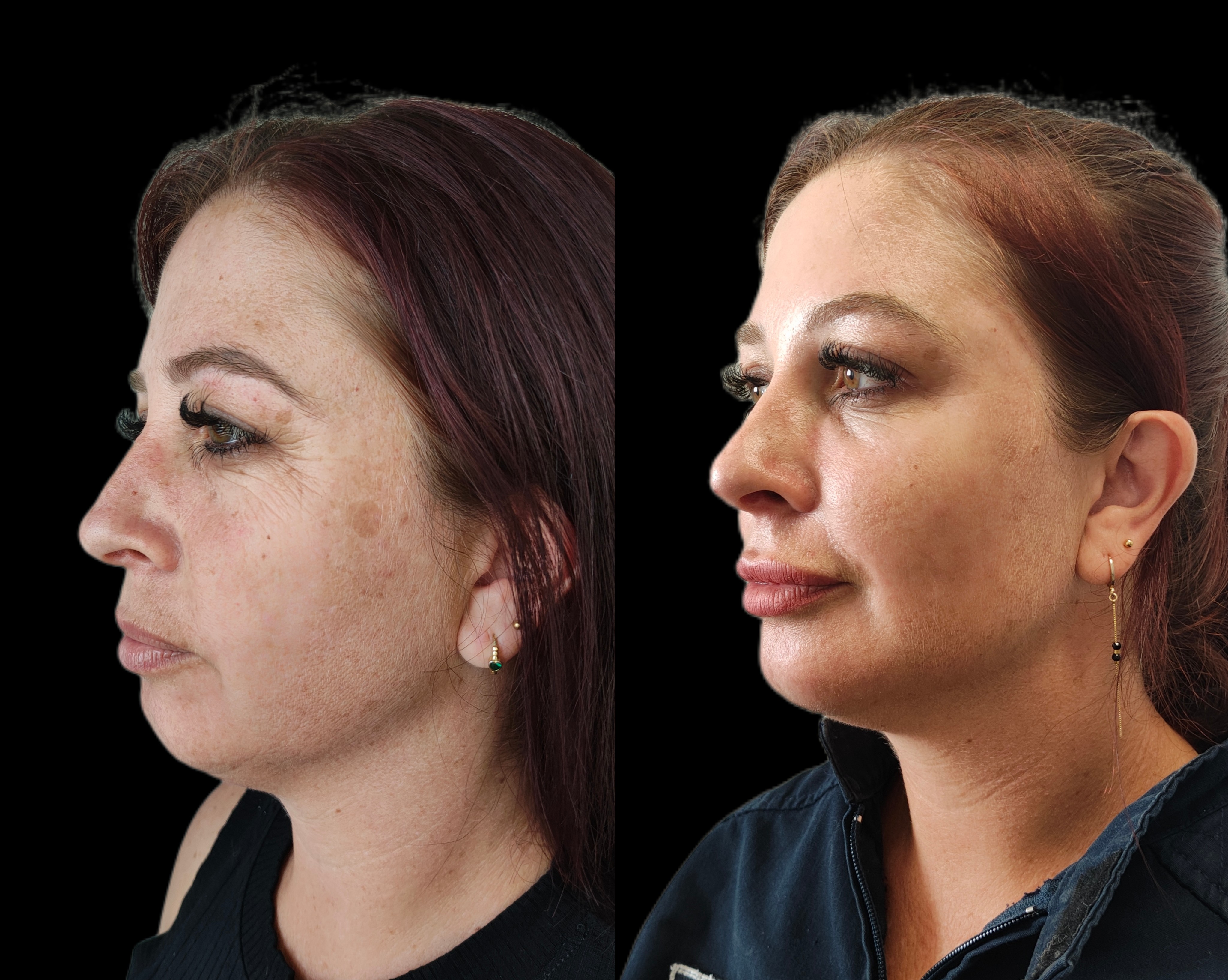 Antes e depois - Preenchimento Facial Full Face