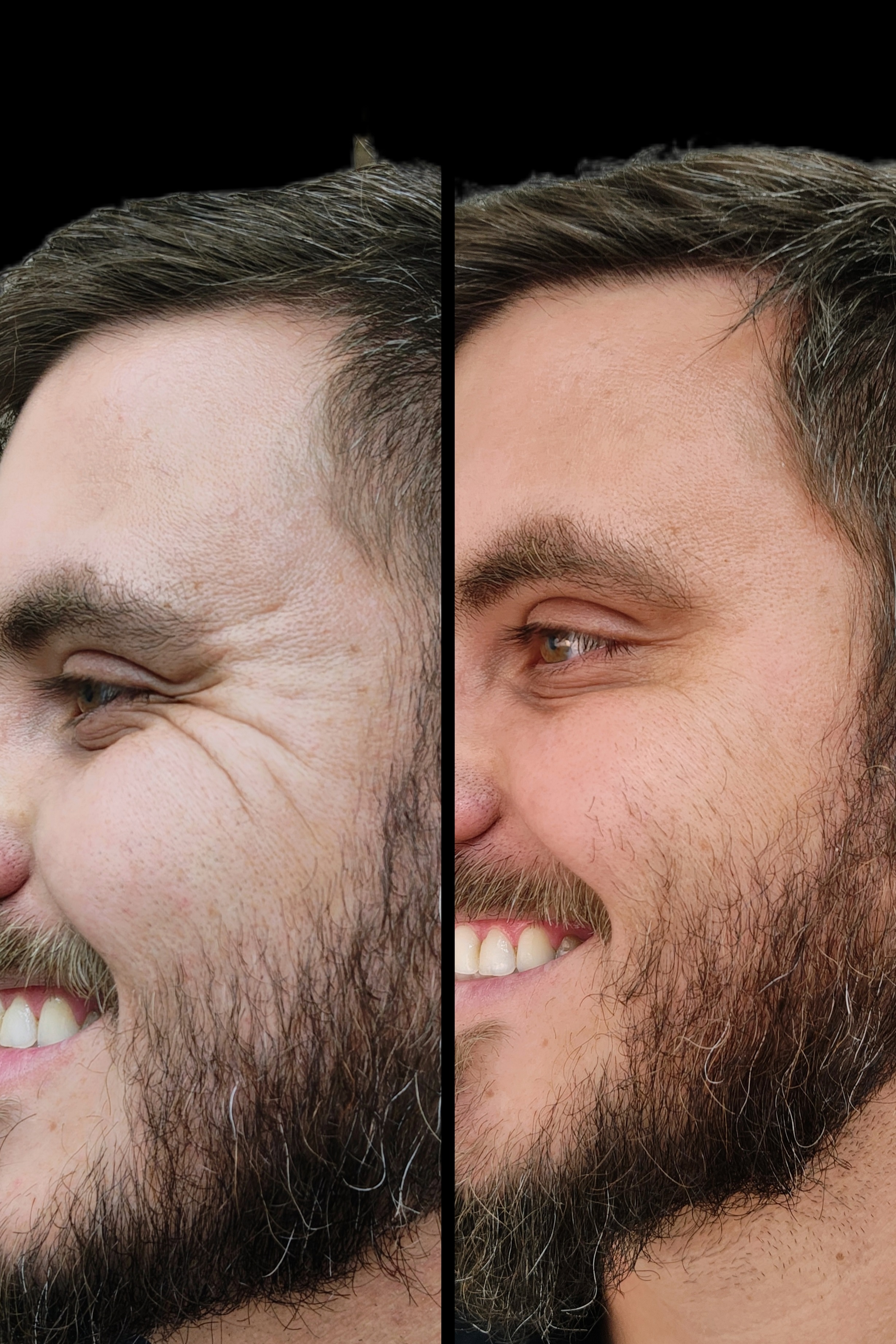 Antes e depois - Toxina Botulínica