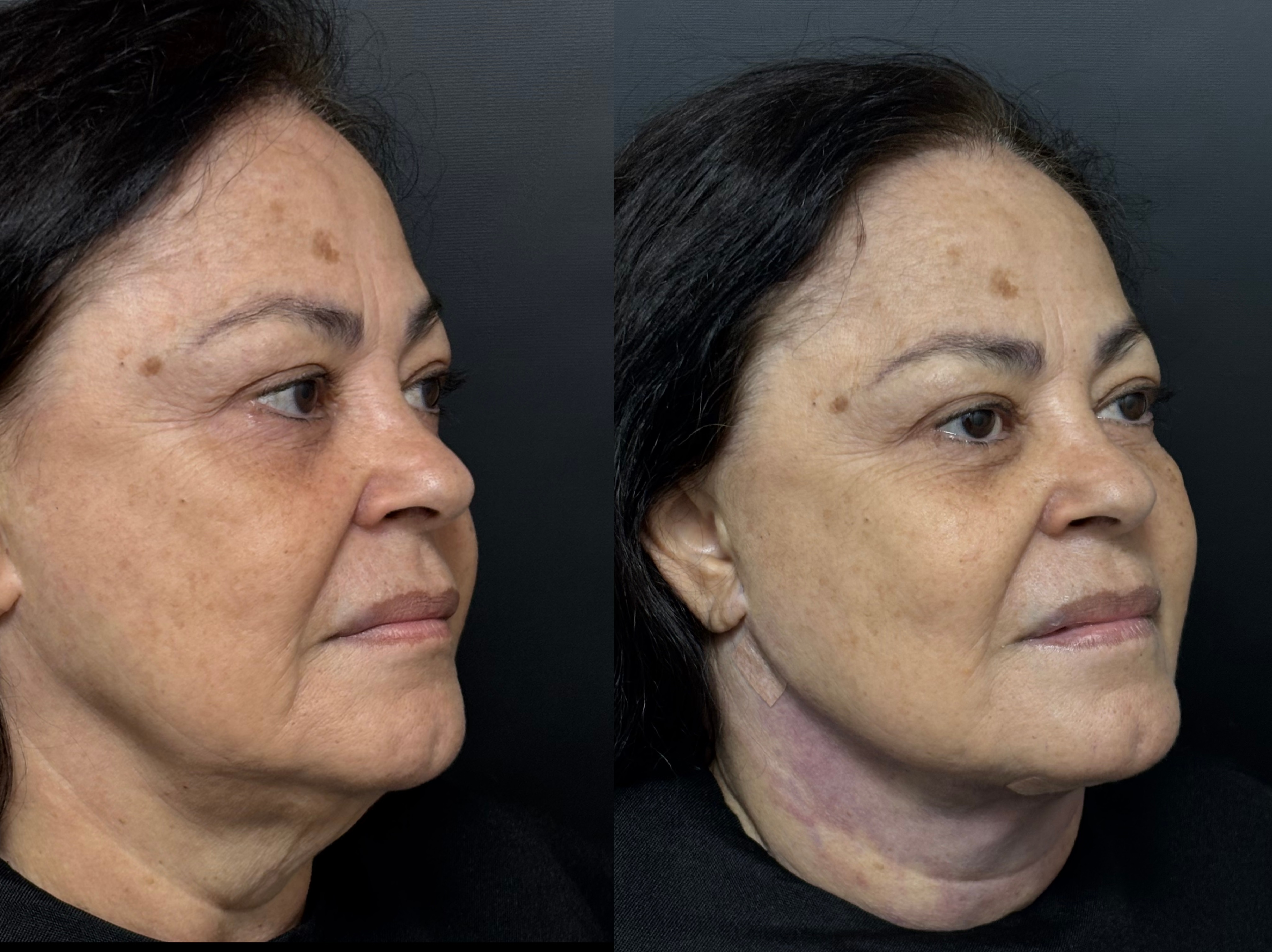 Antes e depois - Lipo de Papada