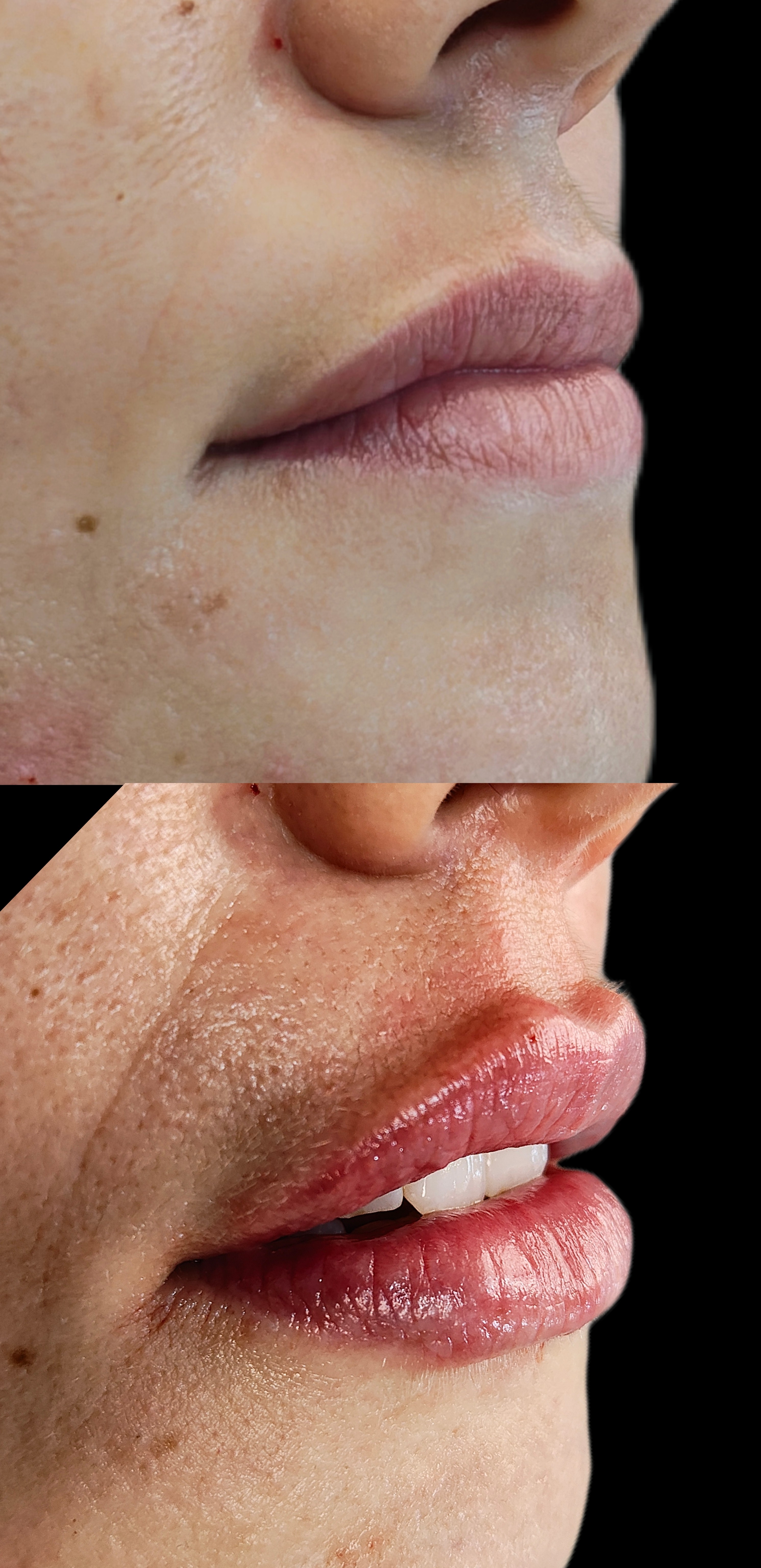 Antes e depois - Preenchimento Labial