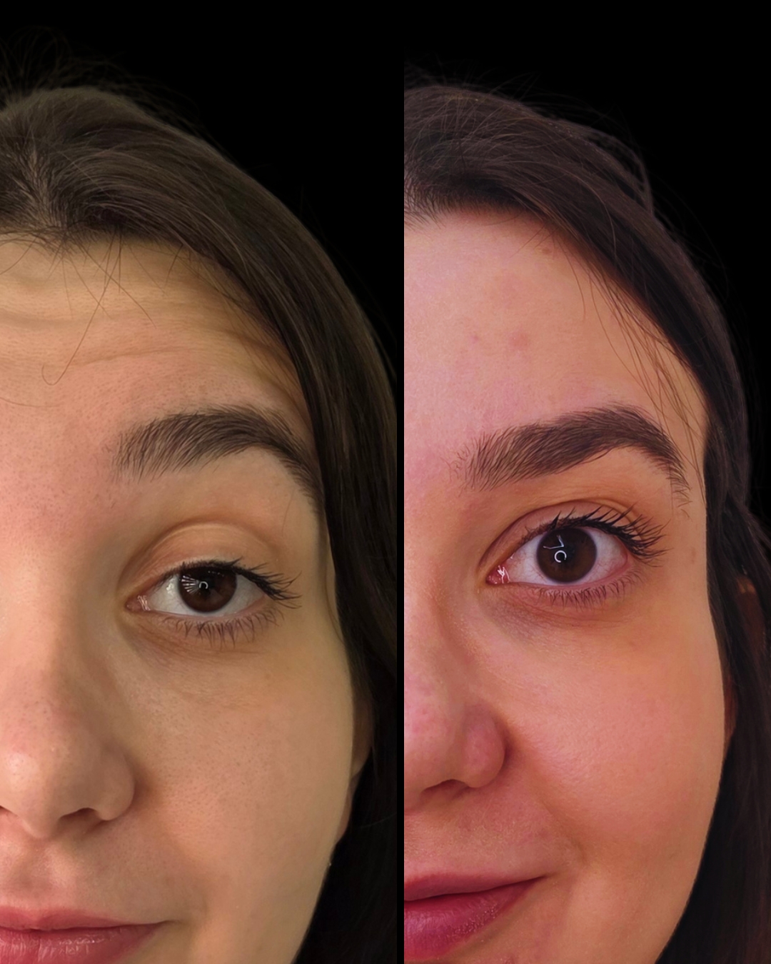 Antes e depois - Toxina Botulínica