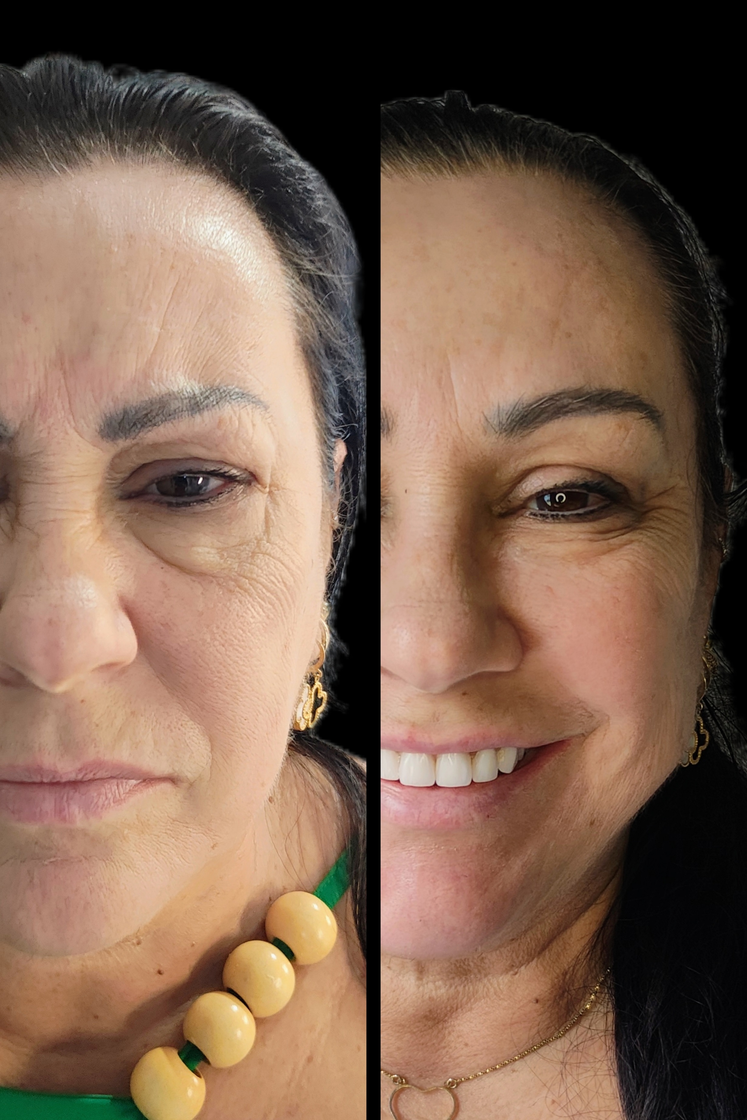 Antes e depois - Preenchimento Facial Full Face