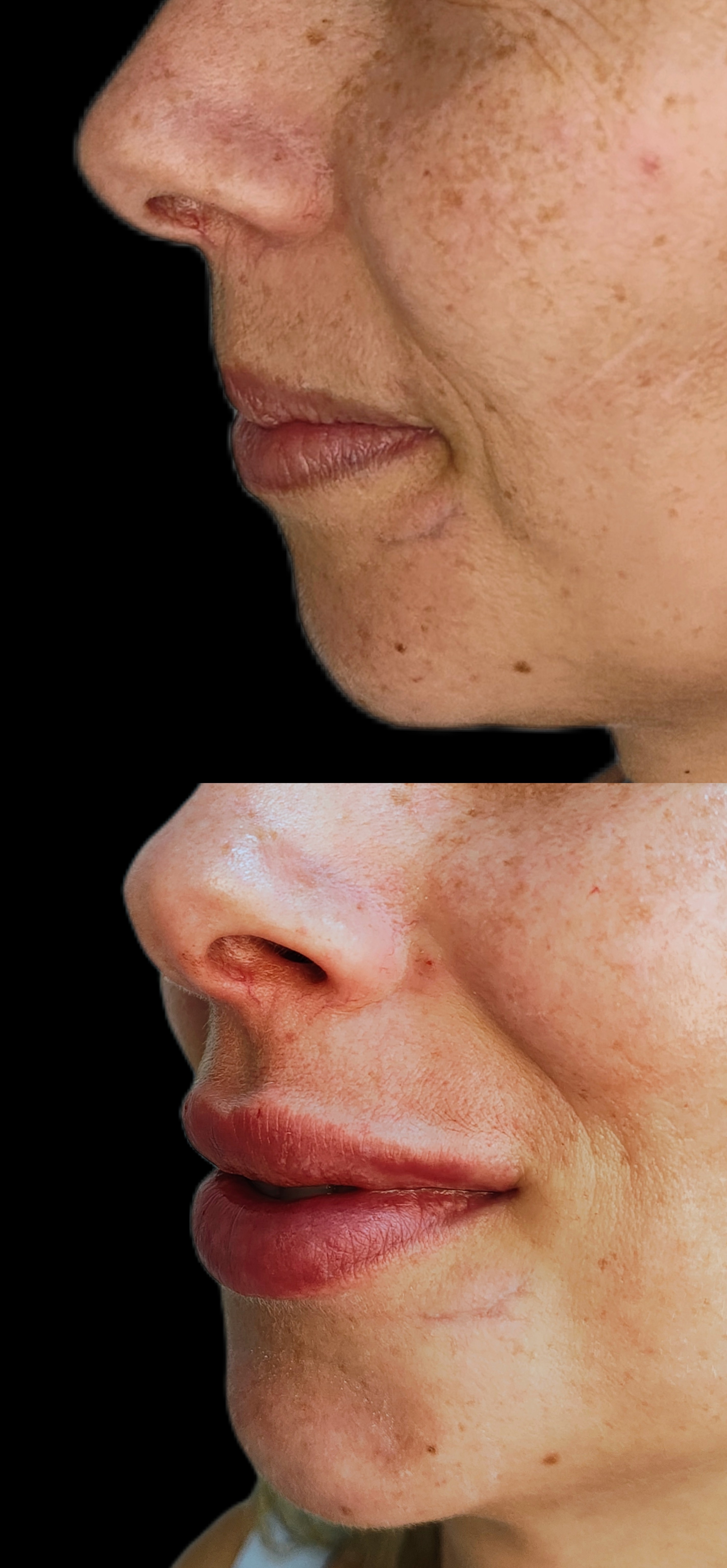 Antes e depois - Preenchimento Labial