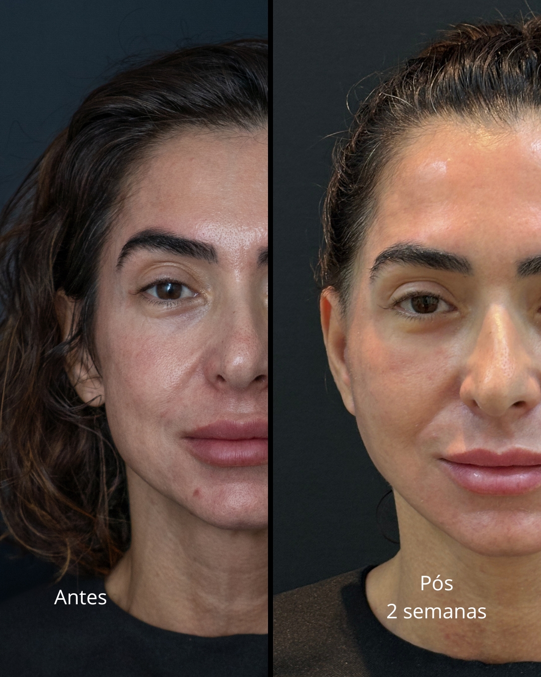 Antes e depois - Lifting Facial Full Face