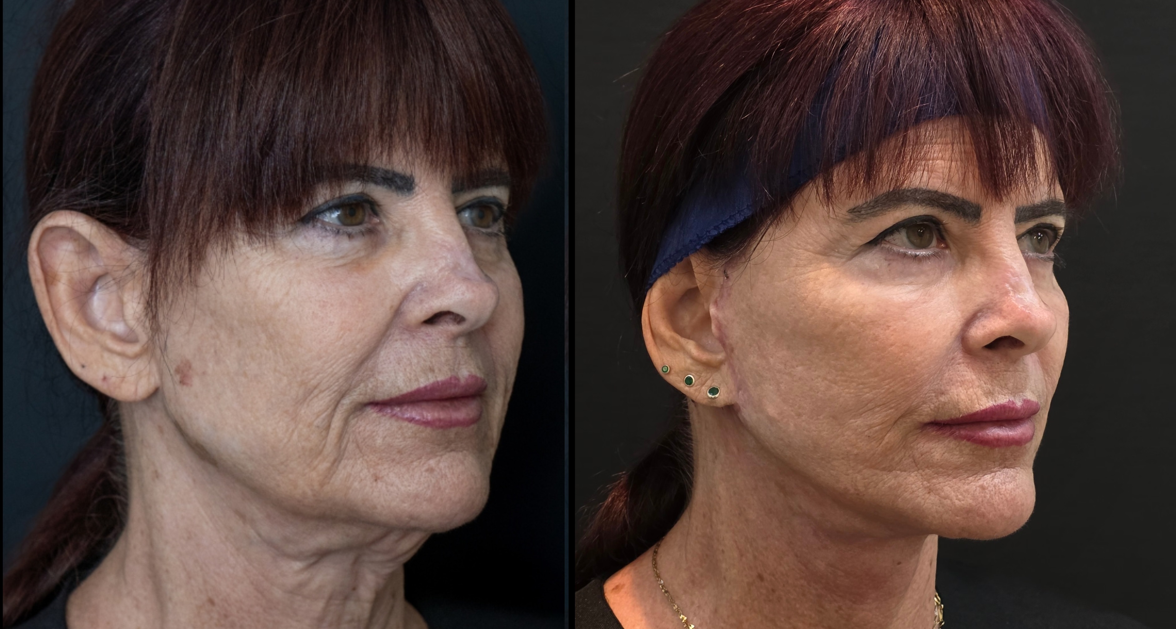 Antes e depois - Lifting Facial Full Face