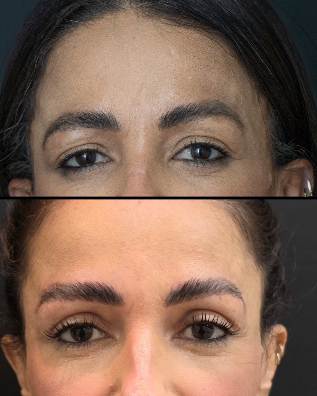 Antes e depois - Blefaroplastia