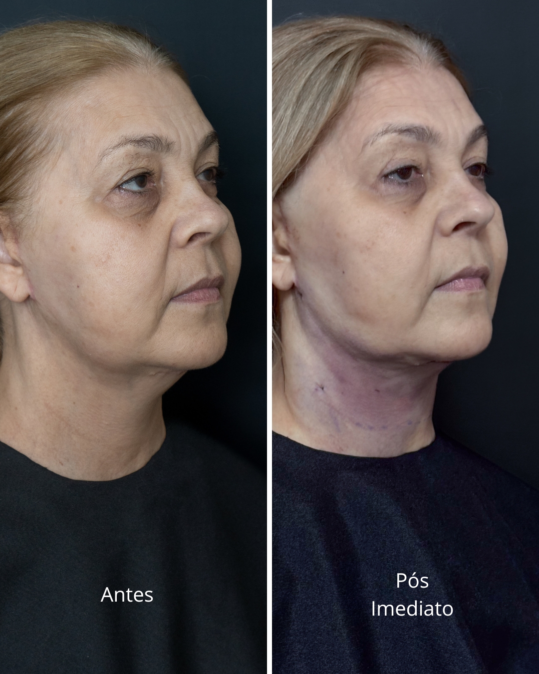 Antes e depois - Lipo de Papada