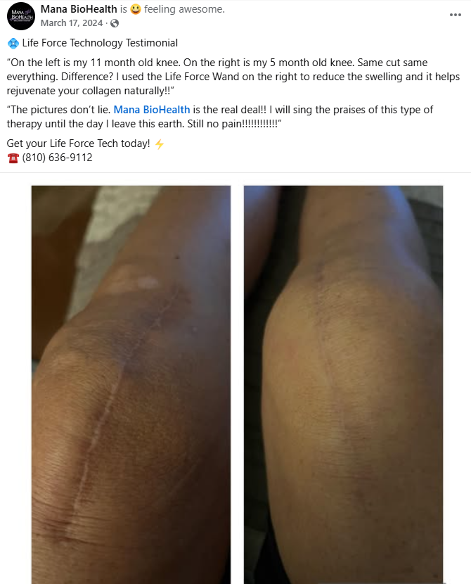 Before and after knee comparison using Life Force Wand - 11 month old vs 5 month old scar showing reduced swelling and improved collagen