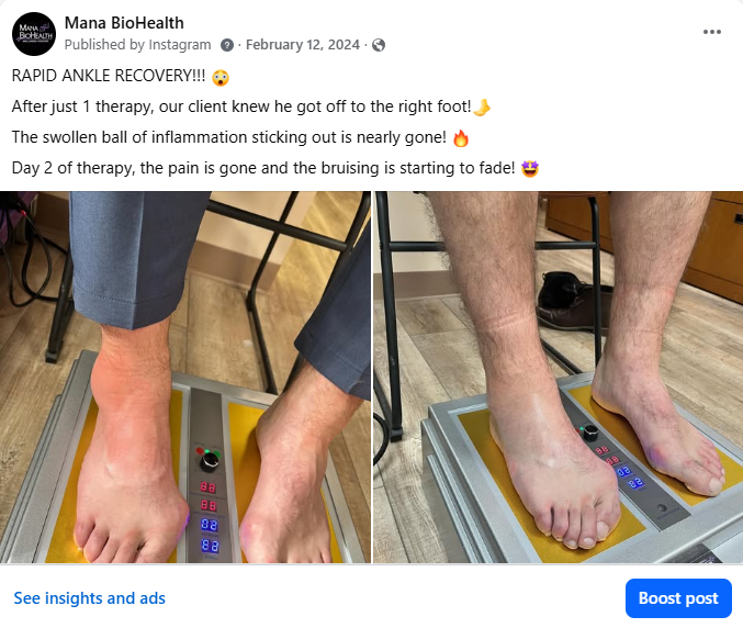 Rapid ankle recovery results after just 1 Life Force Platform therapy — before and after showing reduced swelling and bruising