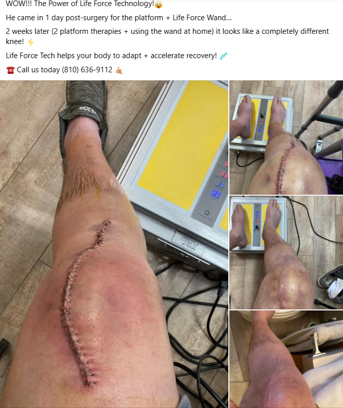 Post-surgery knee recovery results using Life Force Platform and Wand — 1 day vs 2 weeks comparison showing dramatic healing