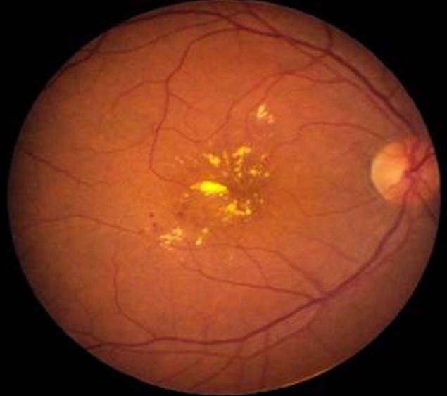 Retinal fundus image