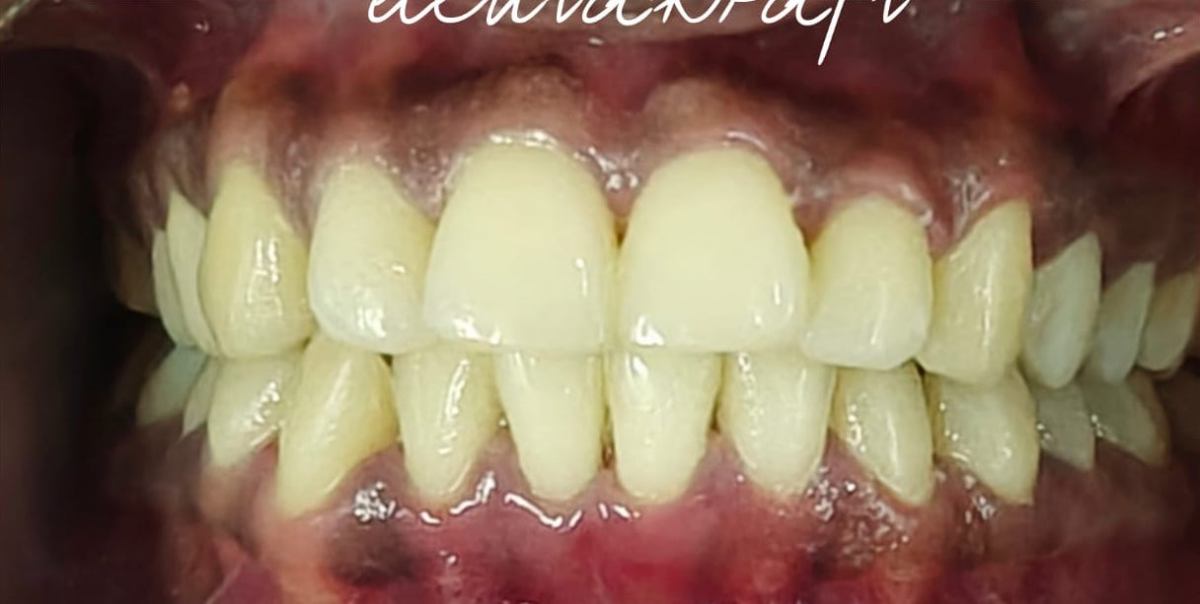 Laser Gum Treatment - After
