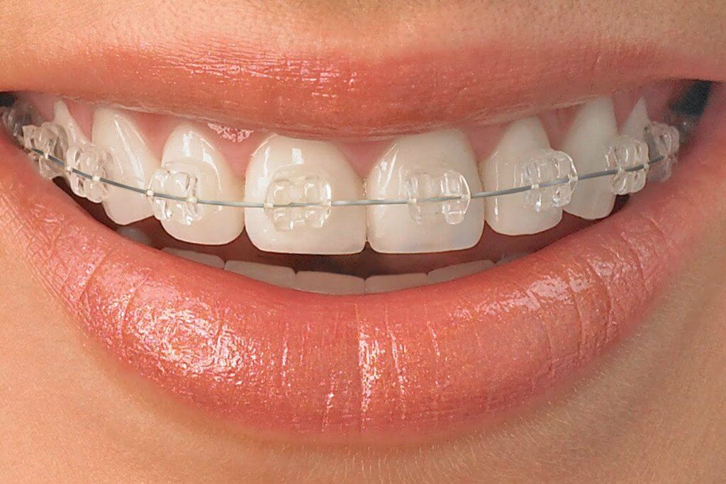 Clear Ceramic Braces