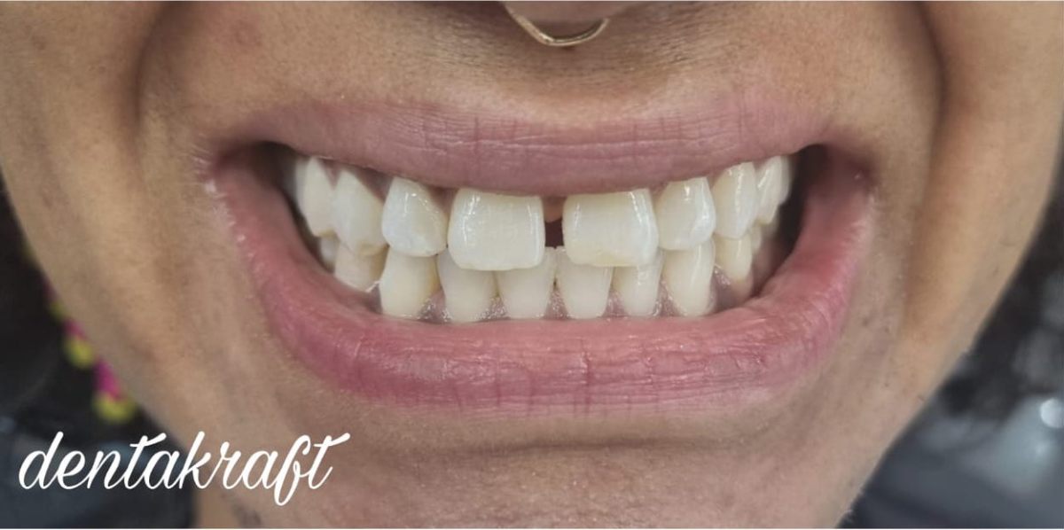 Teeth Whitening - Before