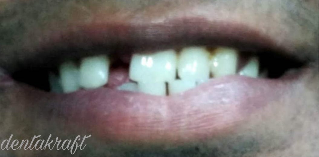 Fixed Bridge Prosthesis - Before