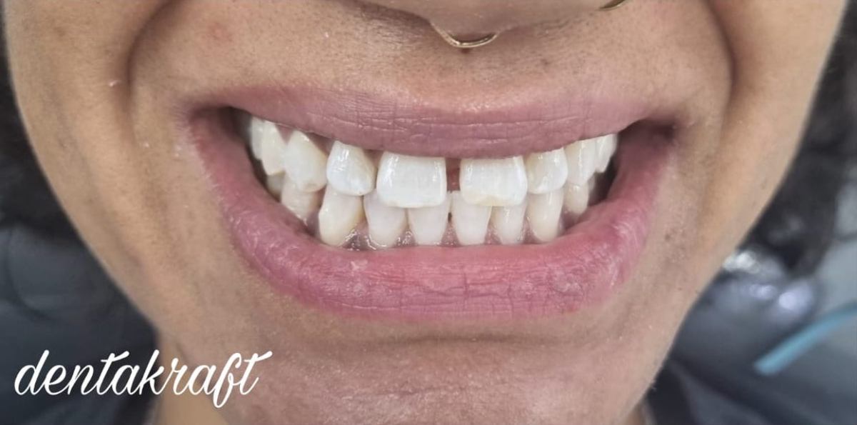 Teeth Whitening - After