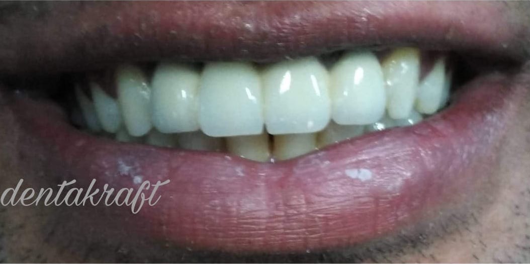 Fixed Bridge Prosthesis - After