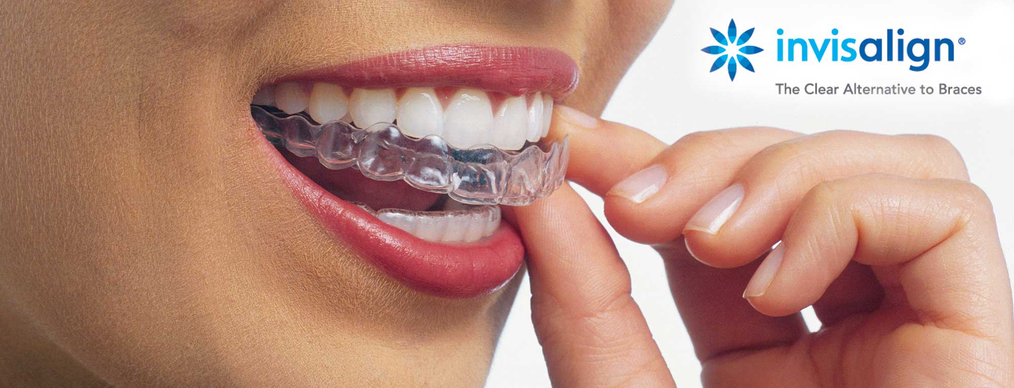 Invisible Aligners