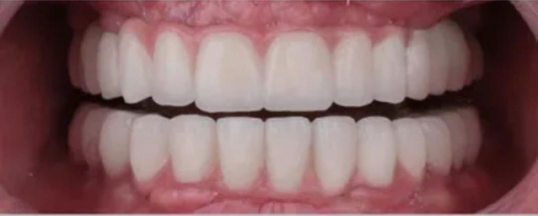 All on 4 Implants - After