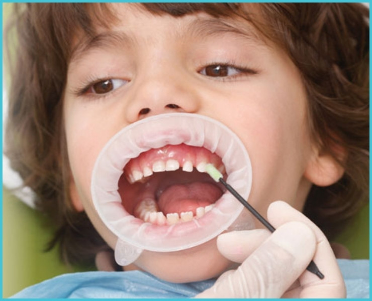 Fluoride Treatments and Dental Sealants