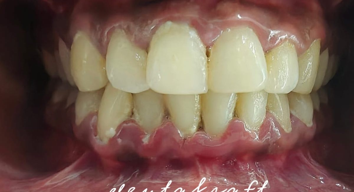 Laser Gum Treatment - Before